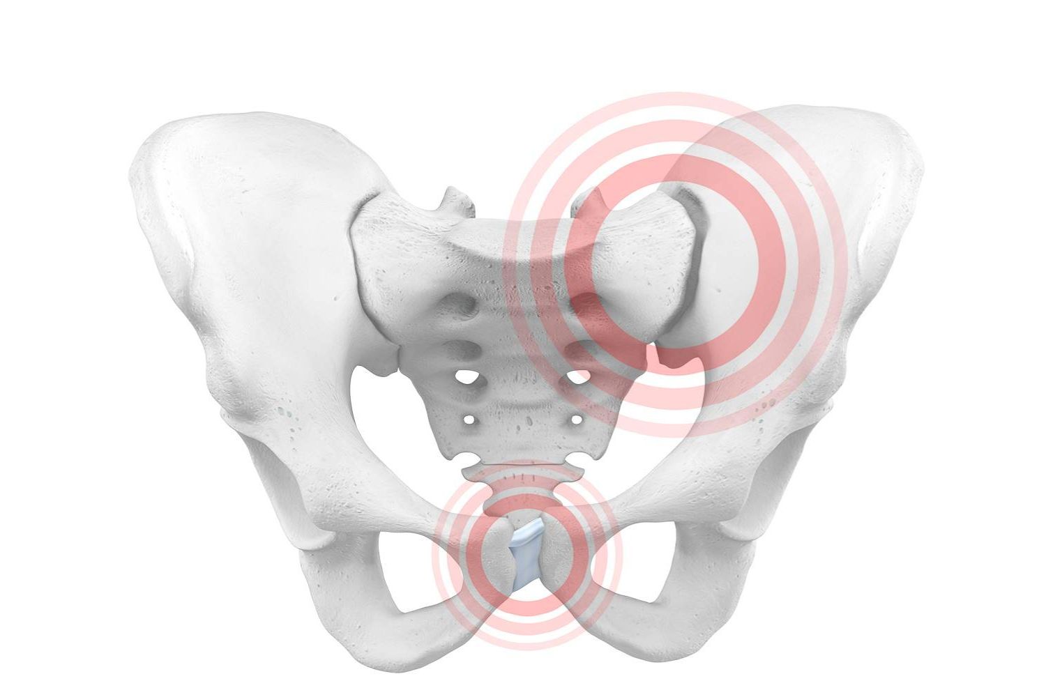 illustration of the pelvic bones. There are two red circles, one over the bottom part of the pelvic and the other near the top right, indicating pelvic girdle instability.