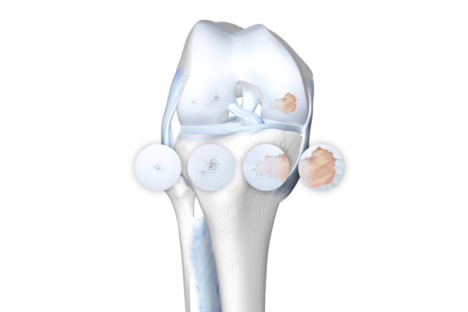 Arthritis In the Knee