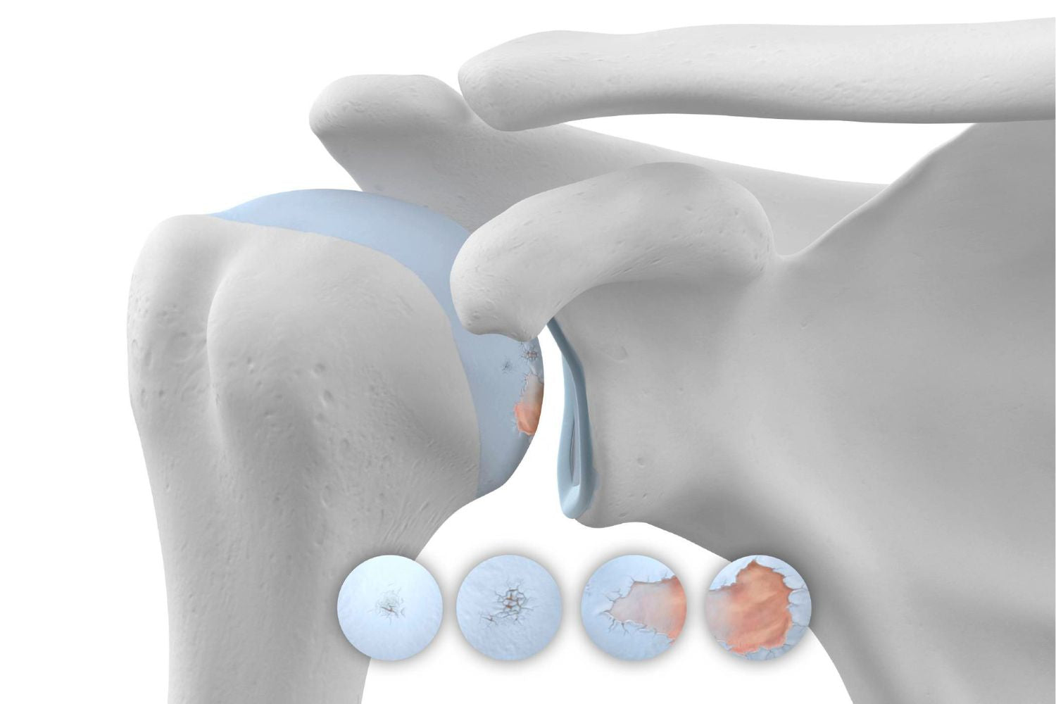 illustration of the skeletal shoulder. It depicts blue cartilage in the shoulder joint with some redness over it, indicating degeneration from shoulder arthritis.