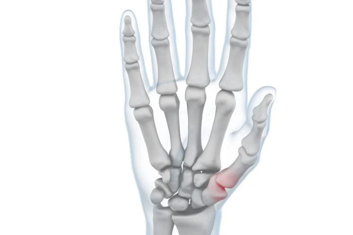 illustration of the hand with see through skin. You can see a red area over the thumb joint, indicating pain.