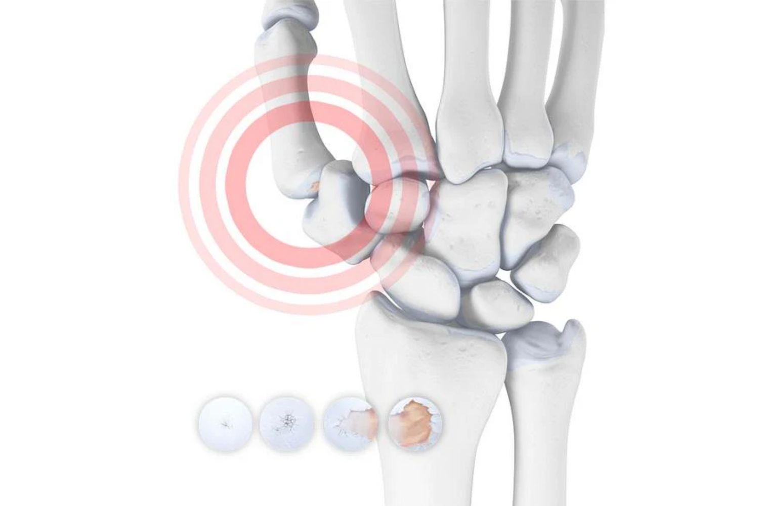 illustration of the skeletal wrist and thumb. Over the ilustration are round images depicting cartilage degeneration. Over the bottom of the thumb is an orange circle, indicating a painful area.
