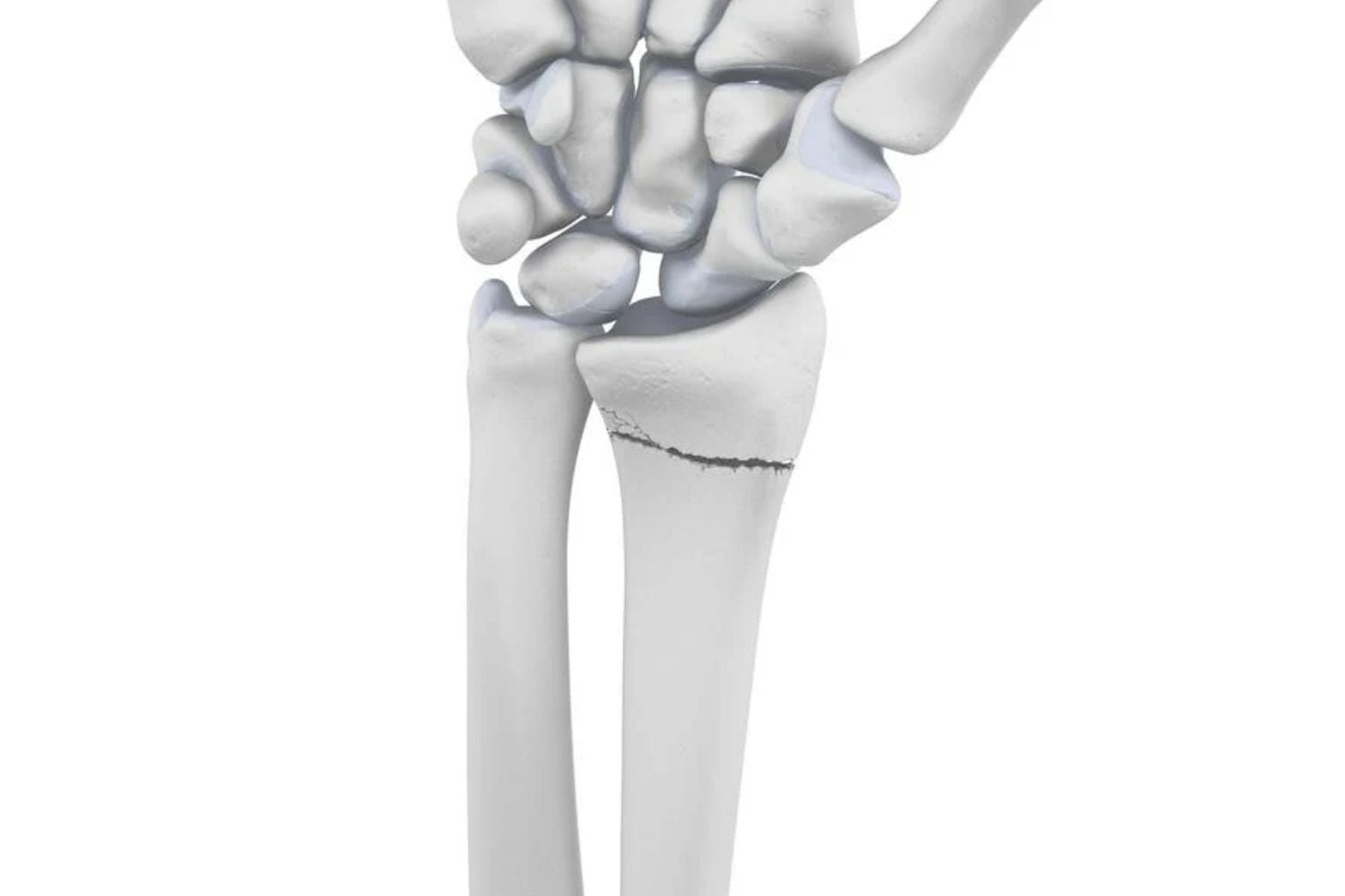 Radius Fracture