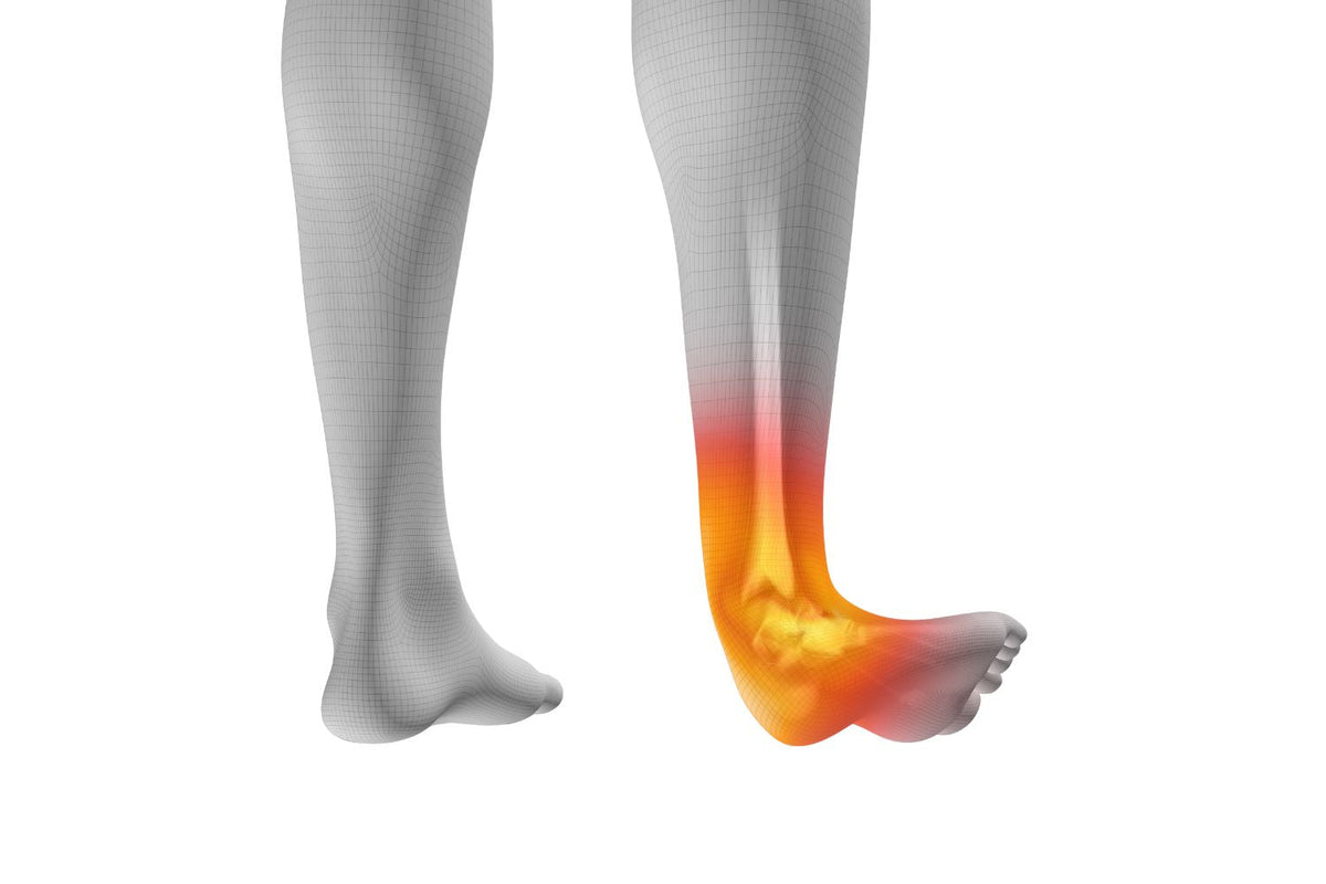 grey legs illustration. The right ankle is everted at a sharp angle and highlighted orange, indicating an ankle sprain