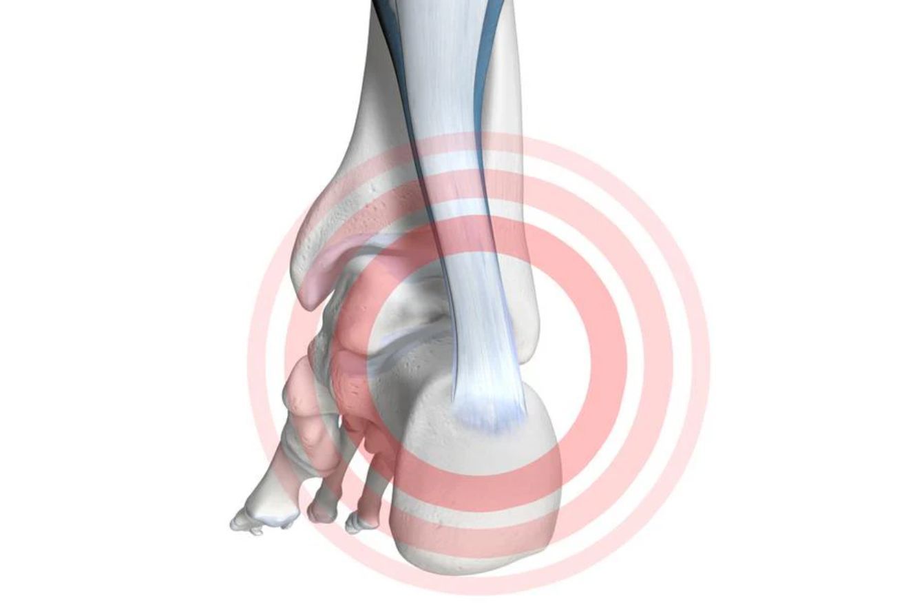 Illustration of the back of the foot and ankle. There is a red circle highlighting Haglund's Deformity in the heel.