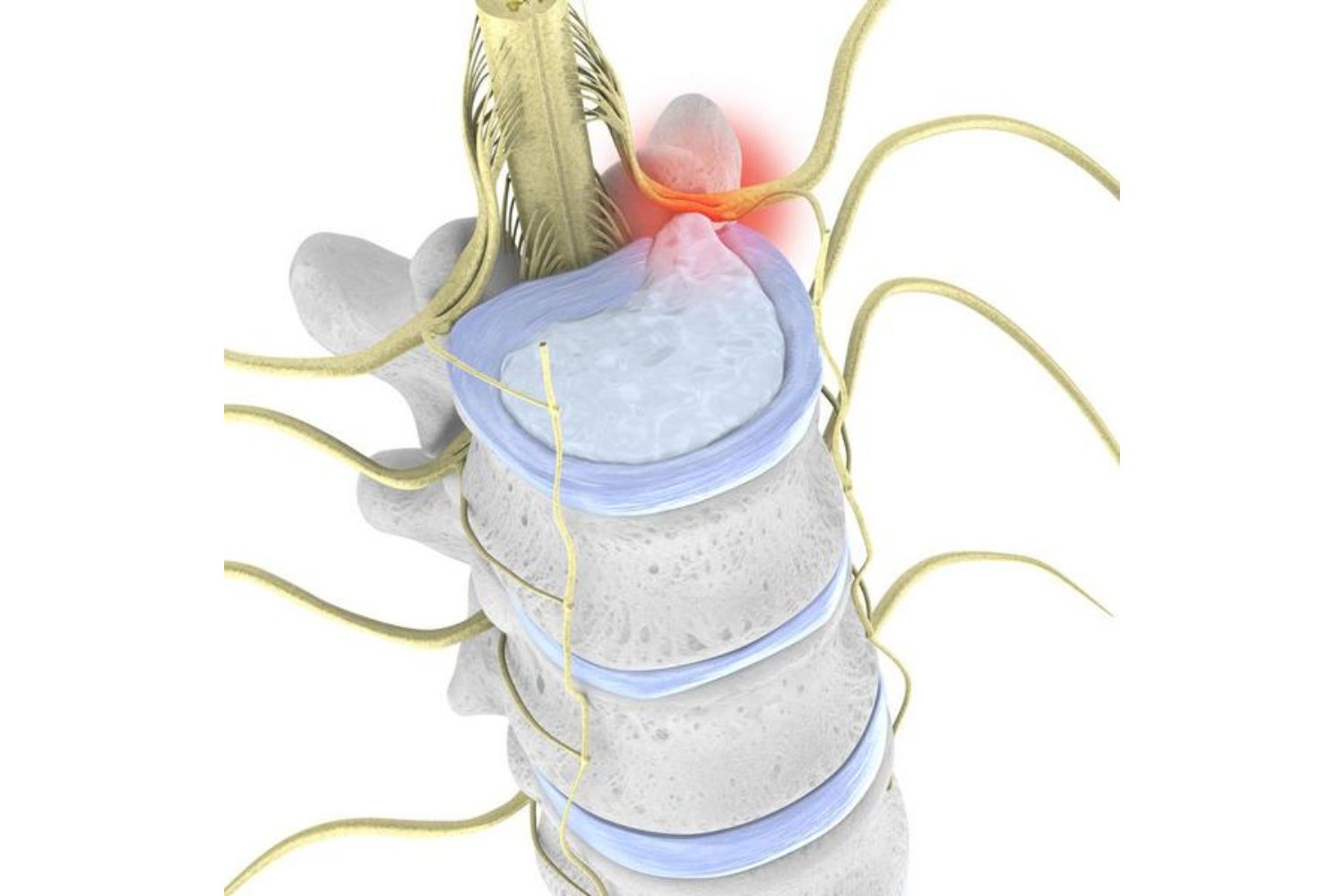 Illustration of the spine. At the top sits a blue disc that is bulging into the spinal column, indicating disc herniation