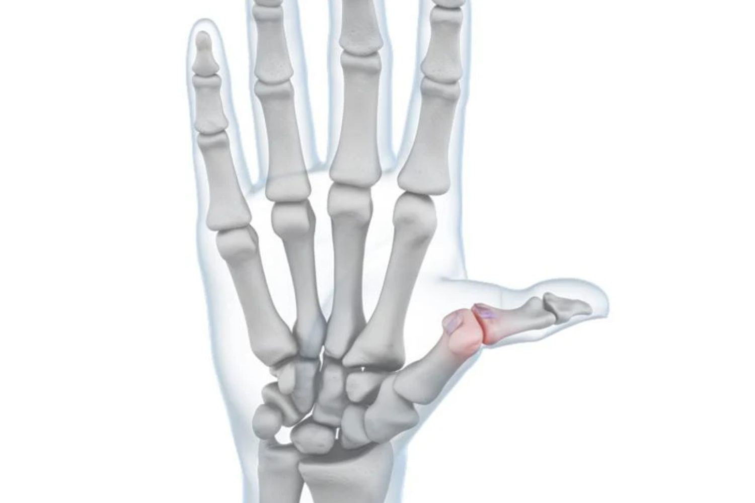 illustration of a hand with see-through skin. There is a red zone over the thumb joint, indicating skier's thumb irritation