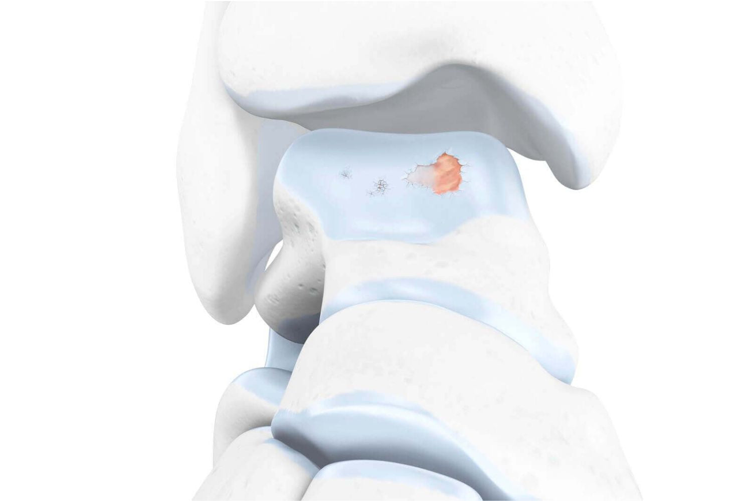 Illustration of the skeletal ankle. The image shows light blue cartilage with a red spot, indicating arthritis wear and tear