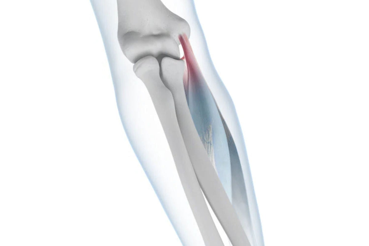 illustration of the arm with se-through skin so you can see the bones and ligaments. One of the epicondyle tendons is red, indicating elbow tendonitis