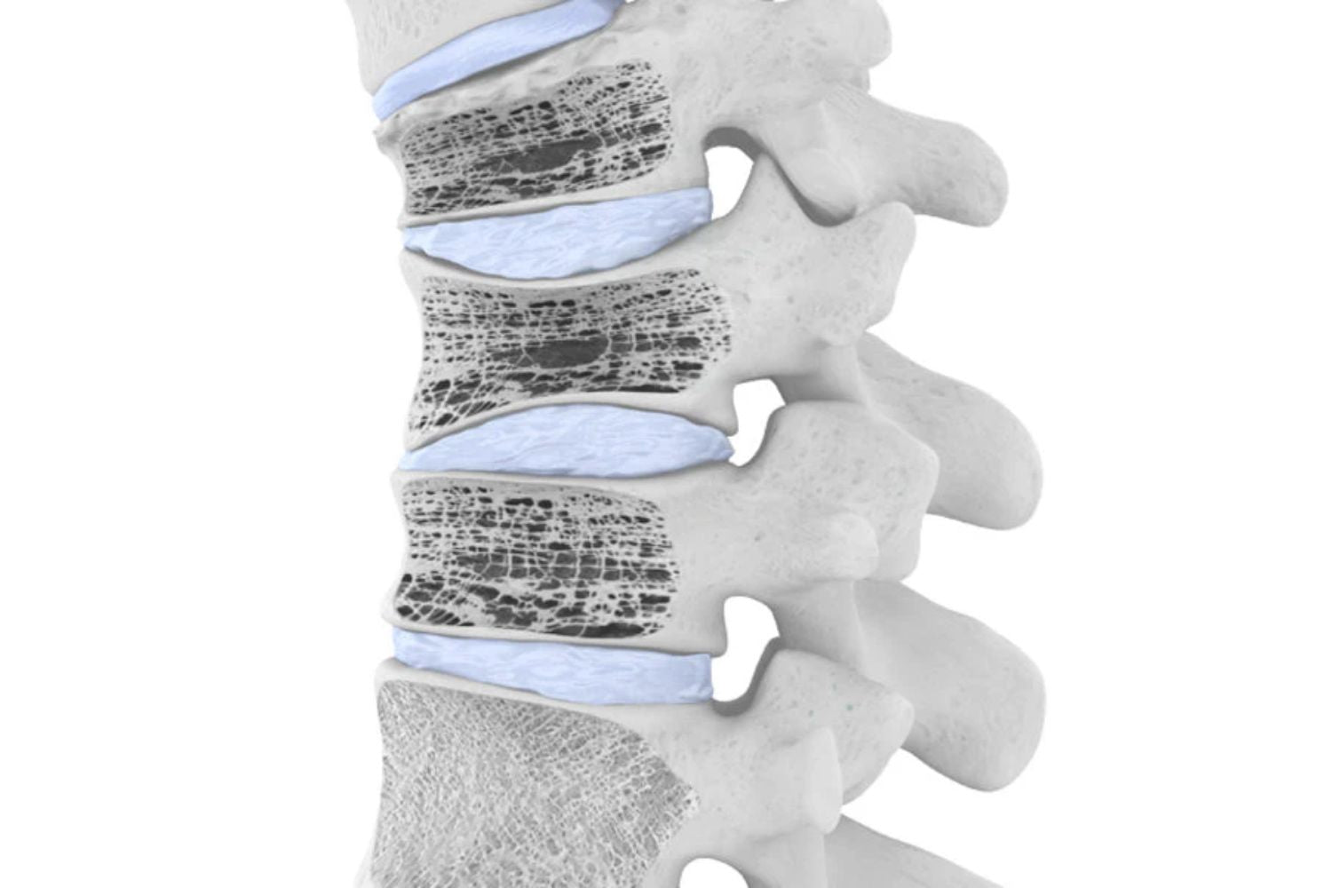 illustration of the spine. 3 of the vertebrae are porous, indicating osteoporosis