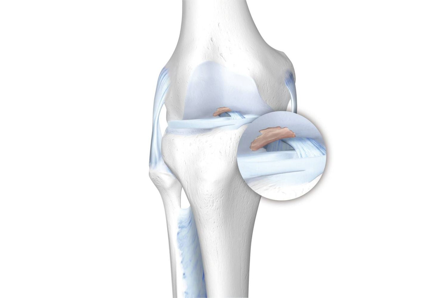 illustration of the skeletal knee. There is redness in the cartilage, indicating osteoarthritis pain and degeneration.