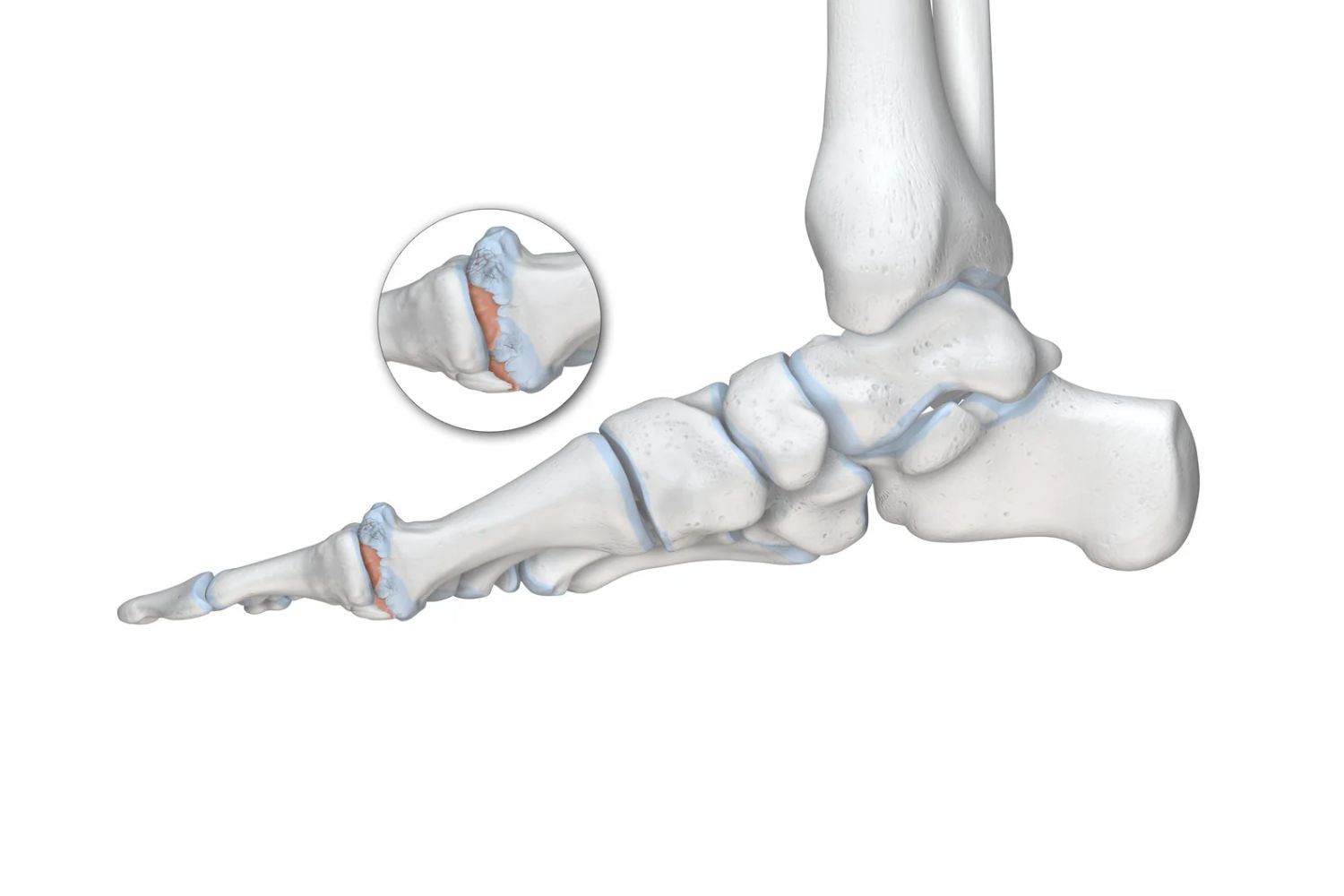illustration of the skeletal foot. There is a round image overtop zooming in on the thumb joint, which is red with irritation, indicating hallux rigidus