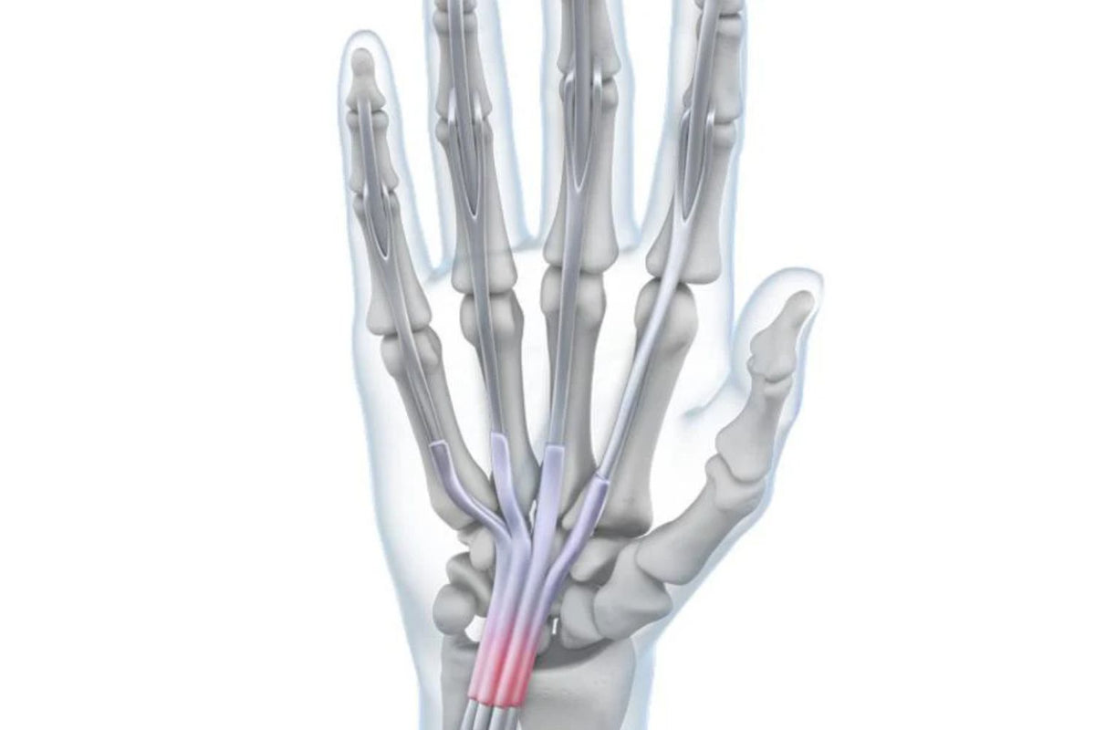 illustration of the hand with see-through skin. There is redness over the wrist tendons, indicating wrist tendonitis pain.