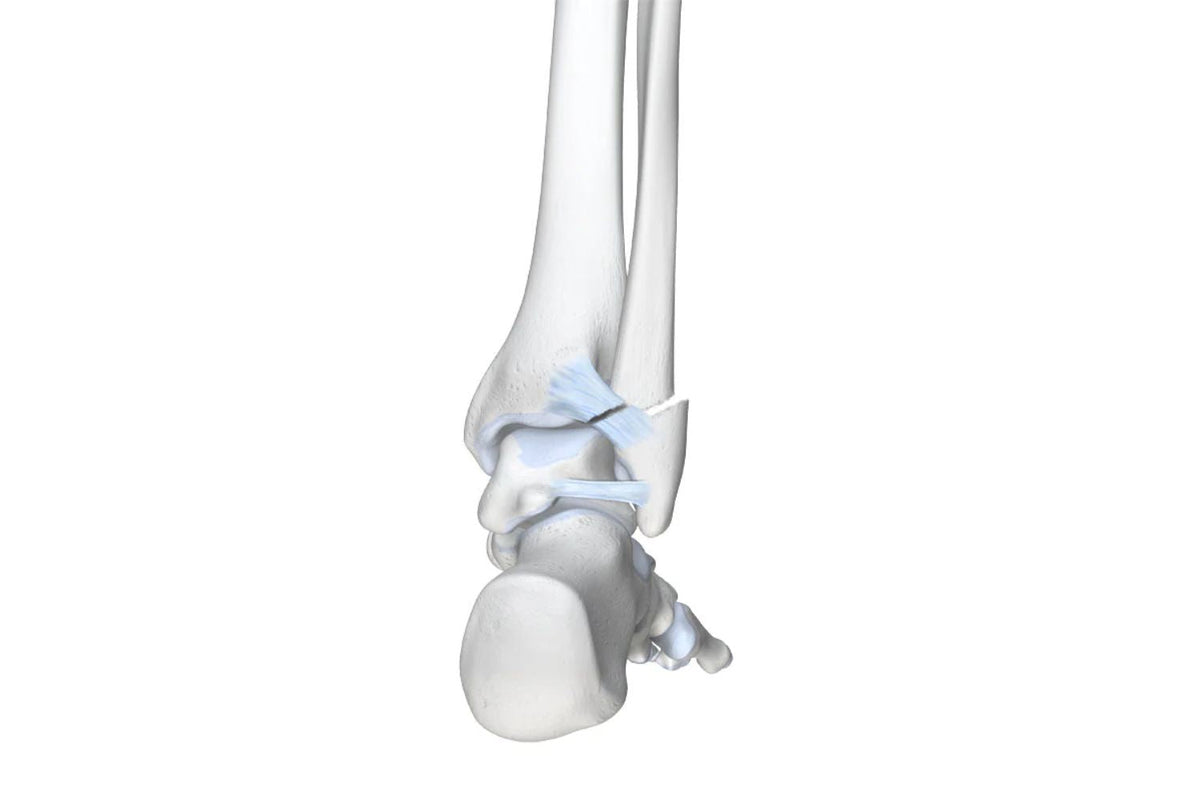 illustration of the skeletal ankle. It shows a large crack in the bone and a tear in the ligament