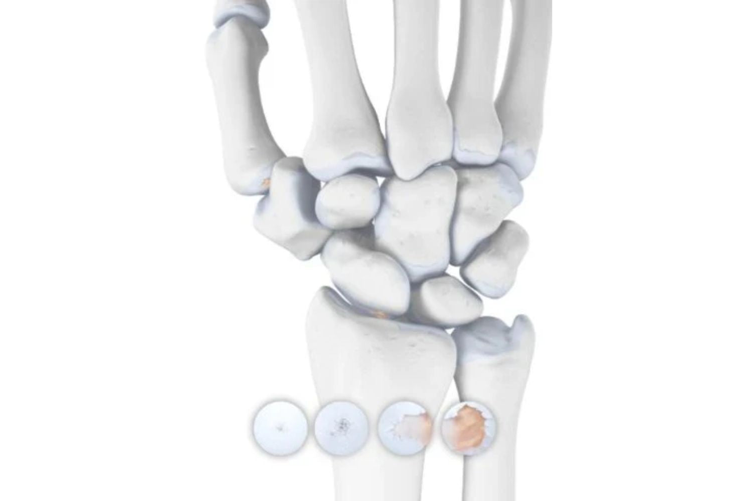 Illustration of the hand and wrist. The cartilage is blue with some red spots, indicating osteoarthritis degeneration