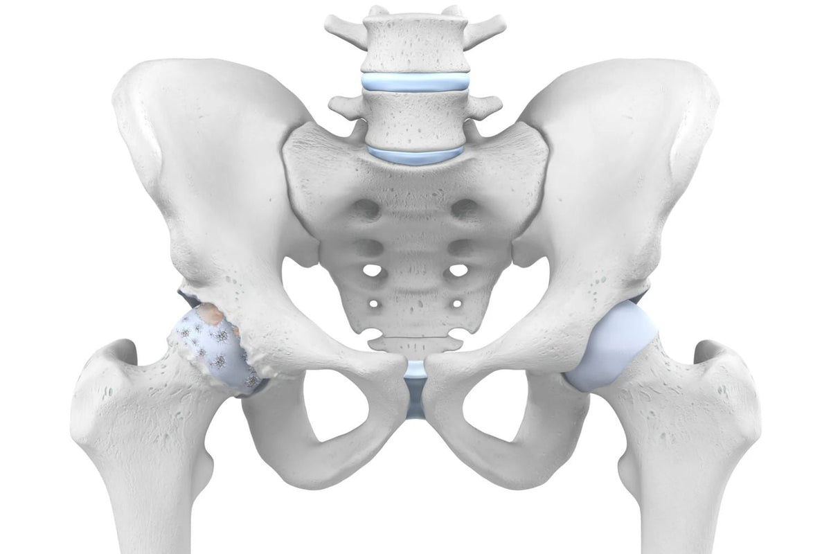 illustration of the skeletal pelvis in grey and light blue. The hip cartilage on the left side is coarser than that on the right, indicating arthritis wear and tear