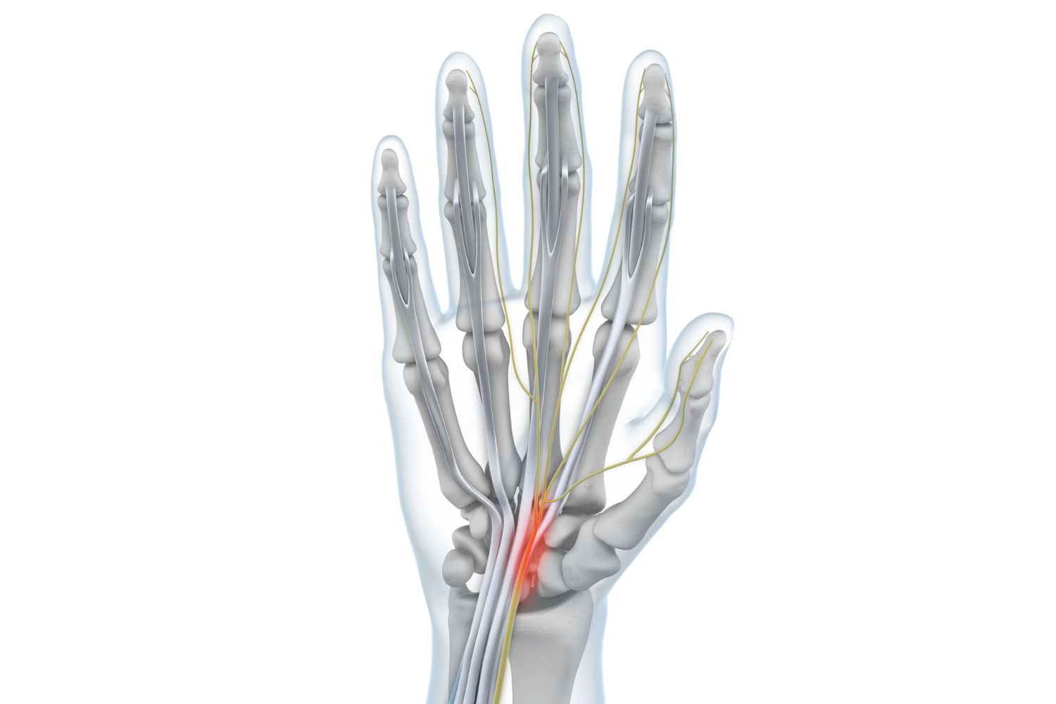 illustration of a hand with see-through skin. The carpal tunnel containing the median nerve is lit up red, indicating carpal tunnel syndrome irritation