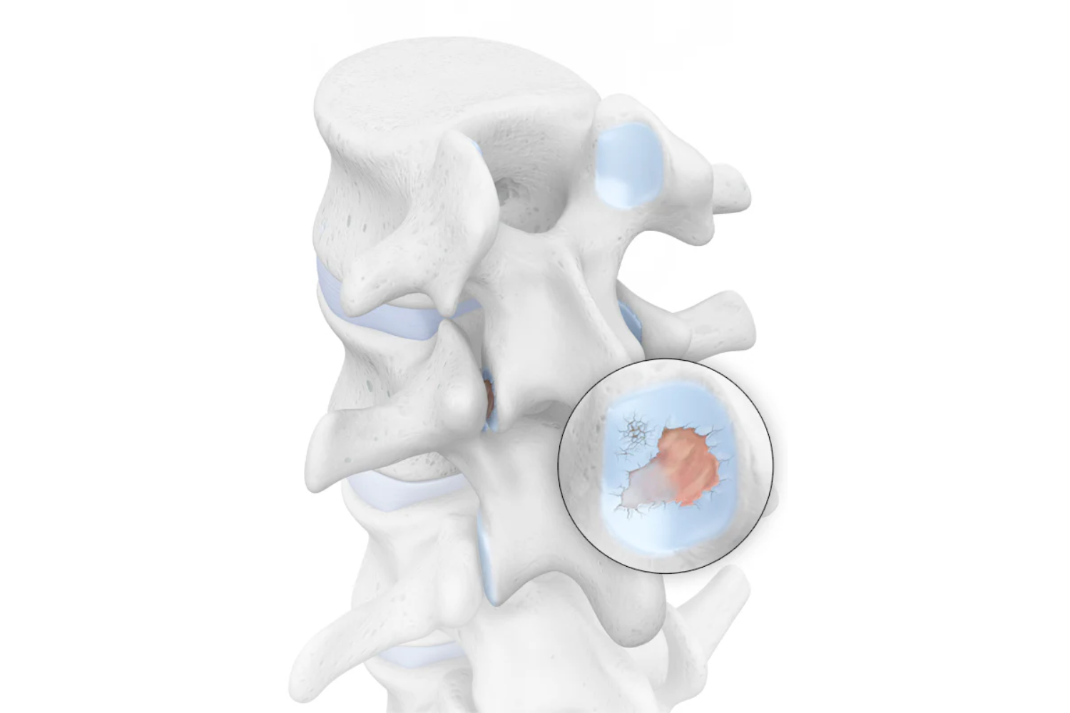 illustration of a handful of spine vertebrae. The image depicts blue cartilage with some orange wear and tear around the facet joints, indicating spondyloarthritis