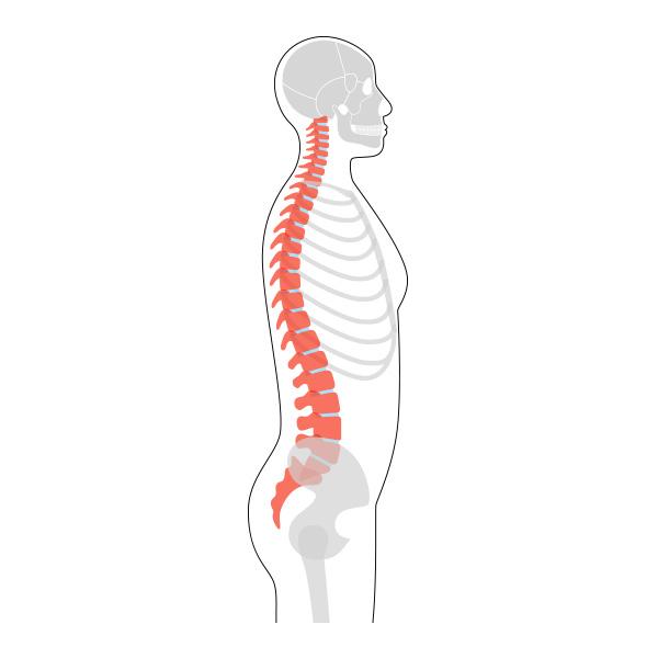 Hyperkyphosis and Dowager’s Hump