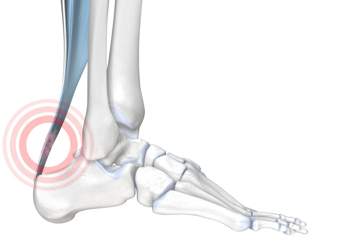 Illustration of the skeletal foot. Side-on view. There is a red circle around the back of he ankle where the Achilles is, indicating Achillodynia pain