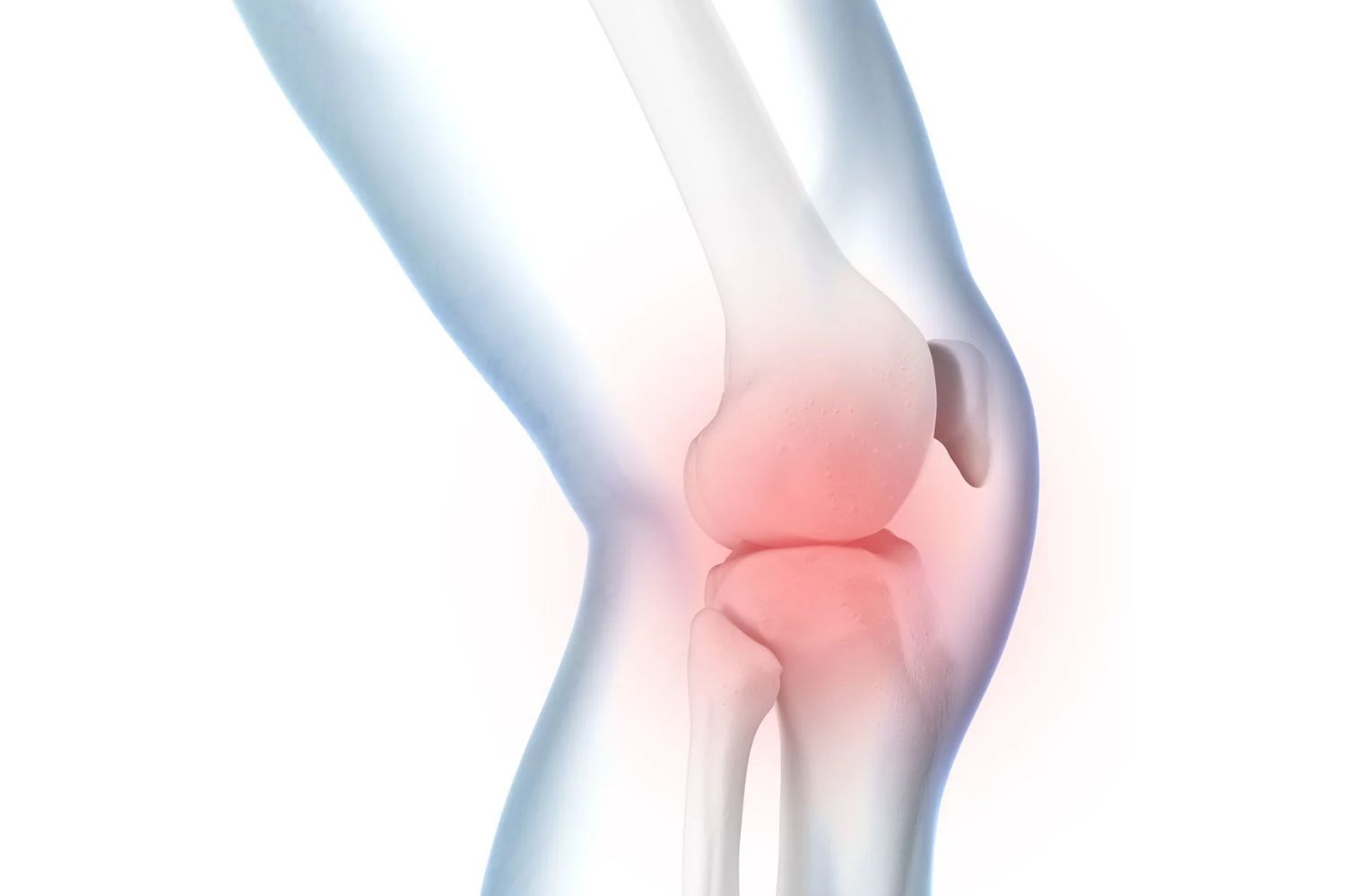 Knee Swelling and Oedema (Effusion)