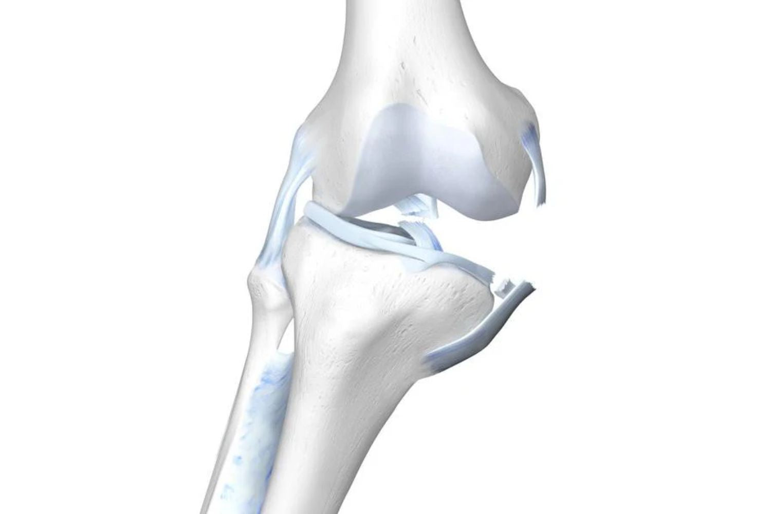 Illustration of the skeletal knee with a damaged ACL, MCL, and meniscus