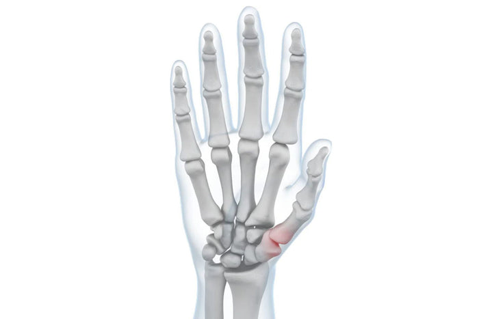 Wrist Osteoarthritis - Arthritis in the Wrist Joint
