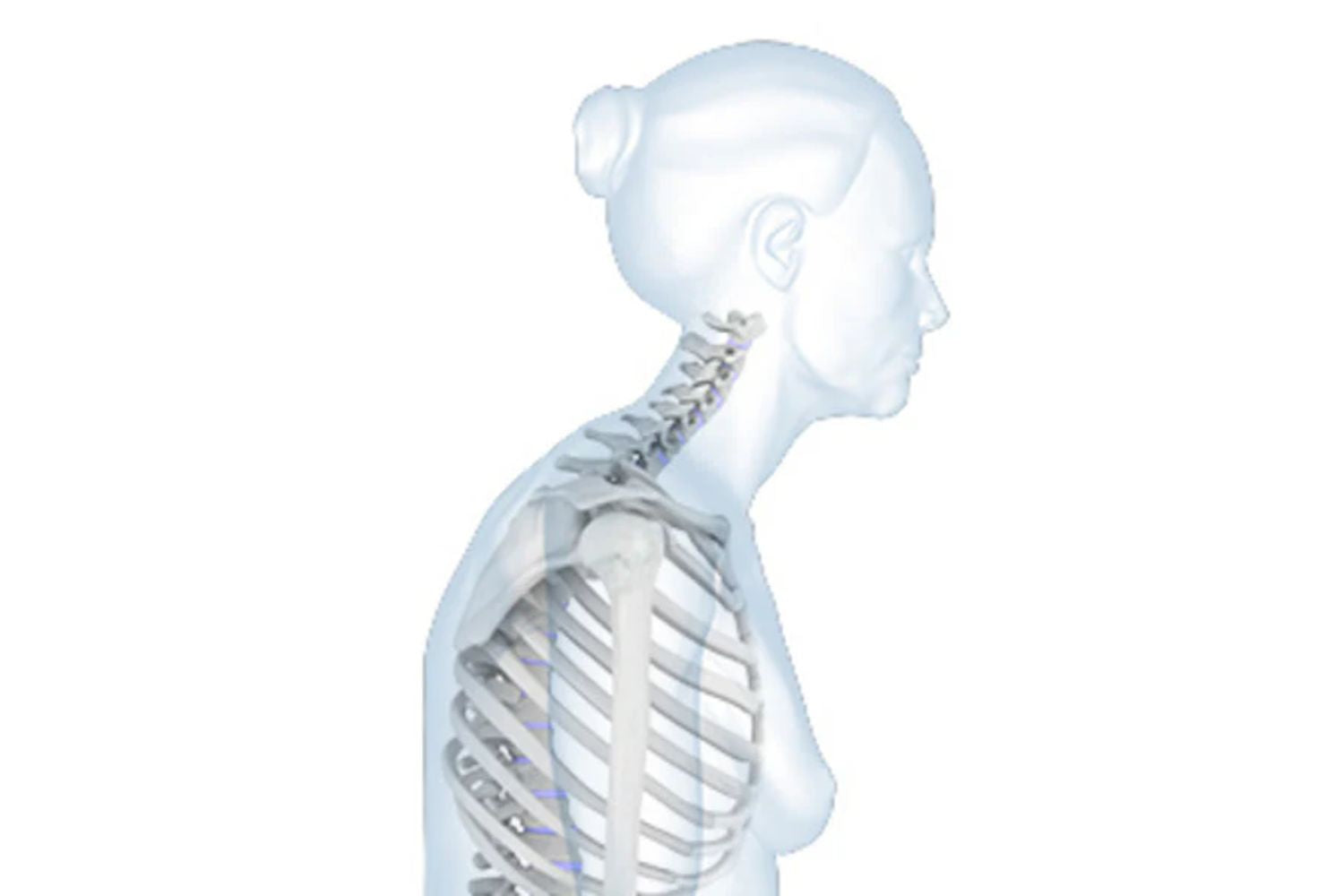Hyperkyphosis and Dowager’s Hump