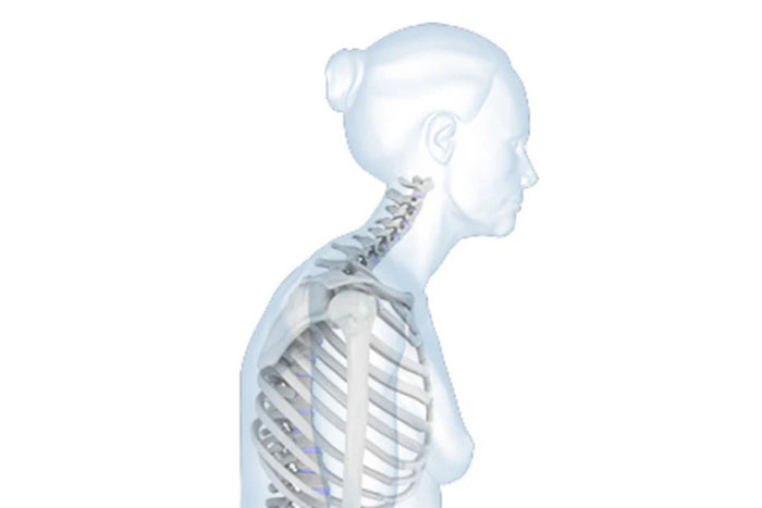 Hyperkyphosis and Dowager’s Hump
