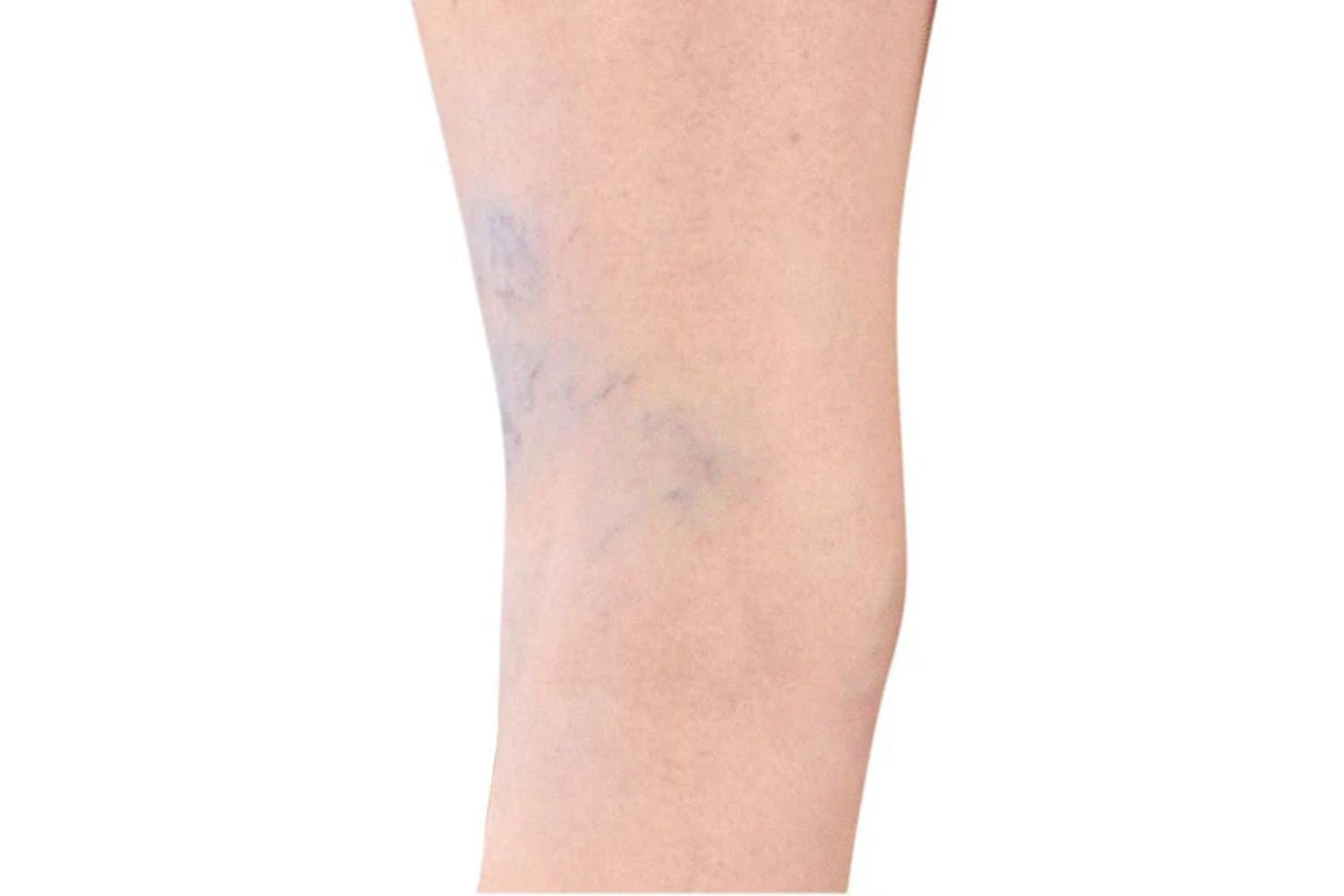 Spider veins on the back of a leg