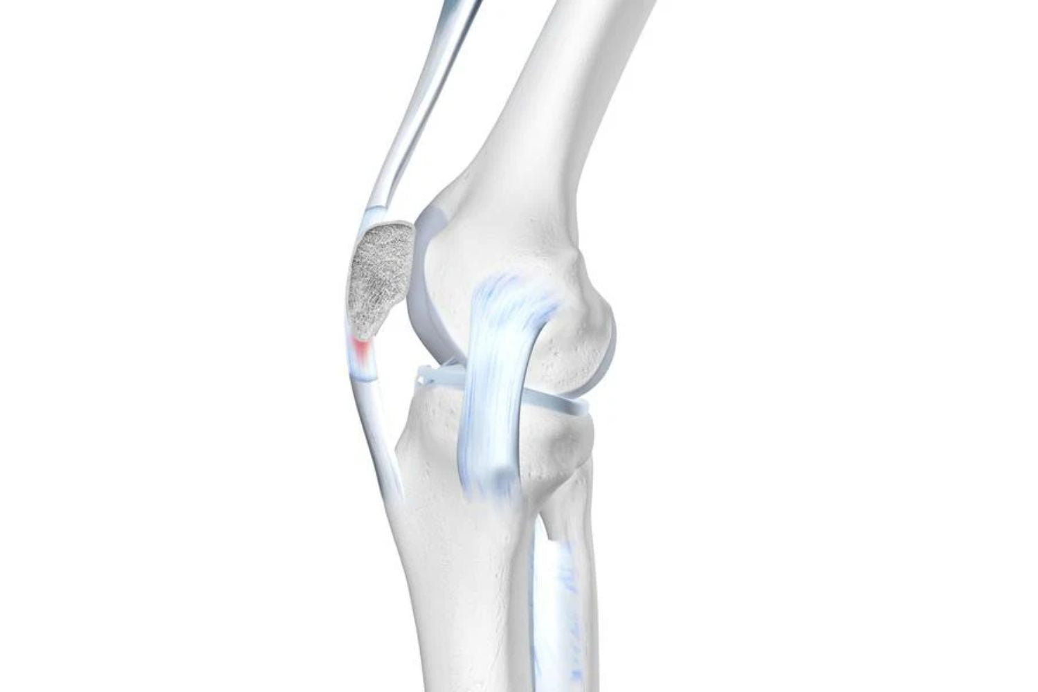 illustration of the skeletal knee. It shows the bony knee joint, the MCL or PCL ligament, and the patellar tendon, which is red to indicate pain.