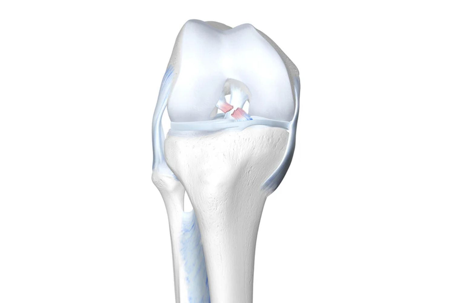 Illustration of a skeletal knee. The cruciate ligament at the centre of the knee is red and ruptured
