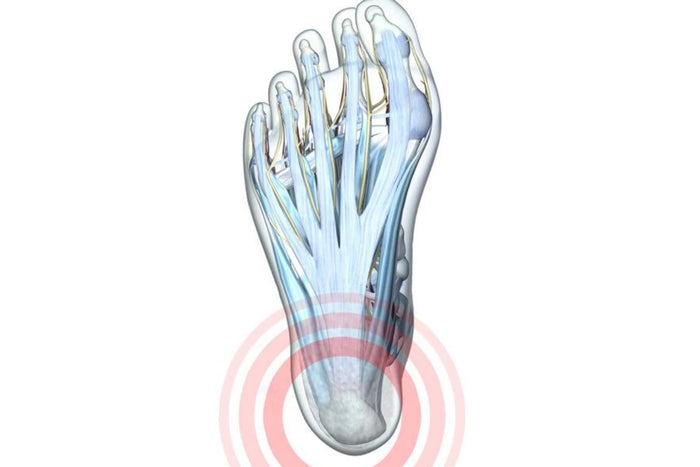 Illustration of the foot with see-through skin. You can see the bones underneath and there is a red circle around the calcaneus, indicating heel pain