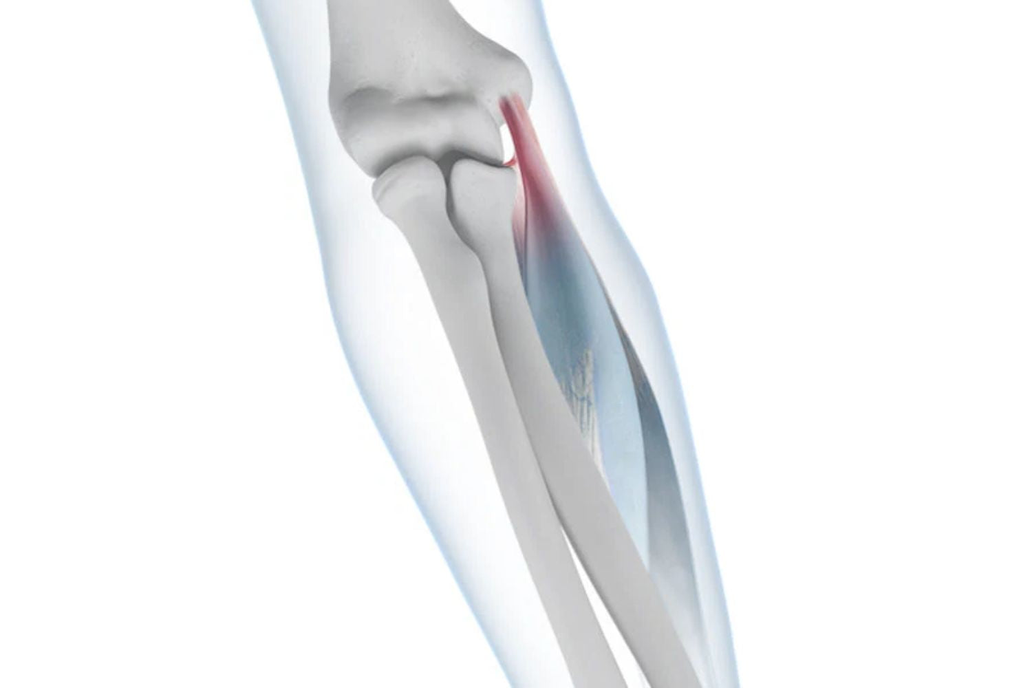 illustration of the arm with se-through skin so you can see the bones and ligaments. One of the epicondyle tendons is red, indicating elbow tendonitis 