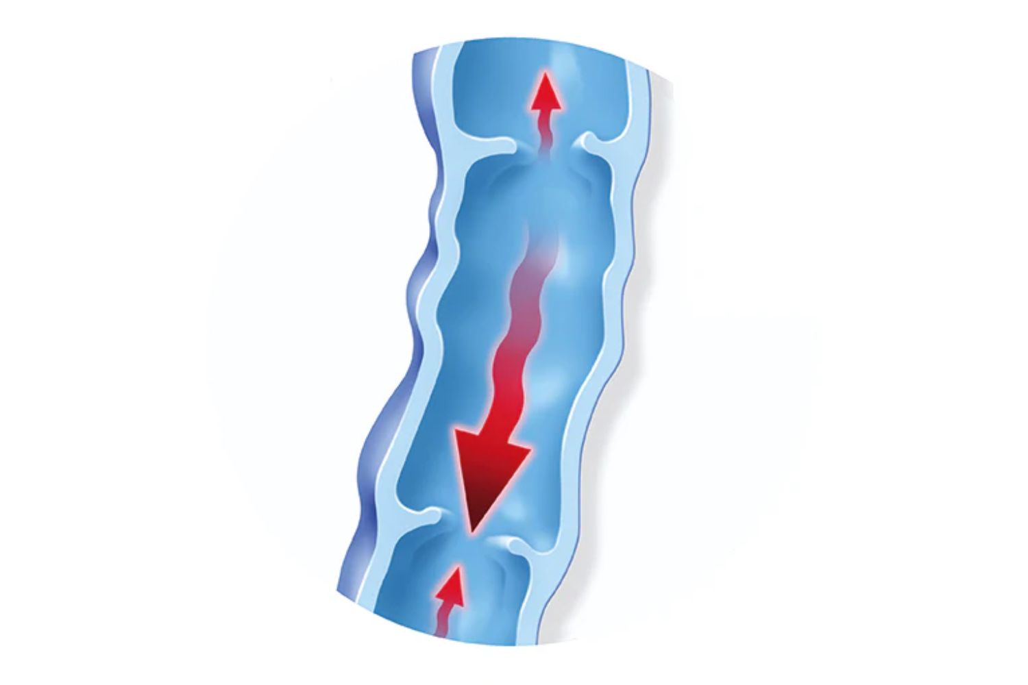 illustration of a varicose vein. The valves are open and blood is flowing backwards instead of upwards, leading to some bulging in the walls