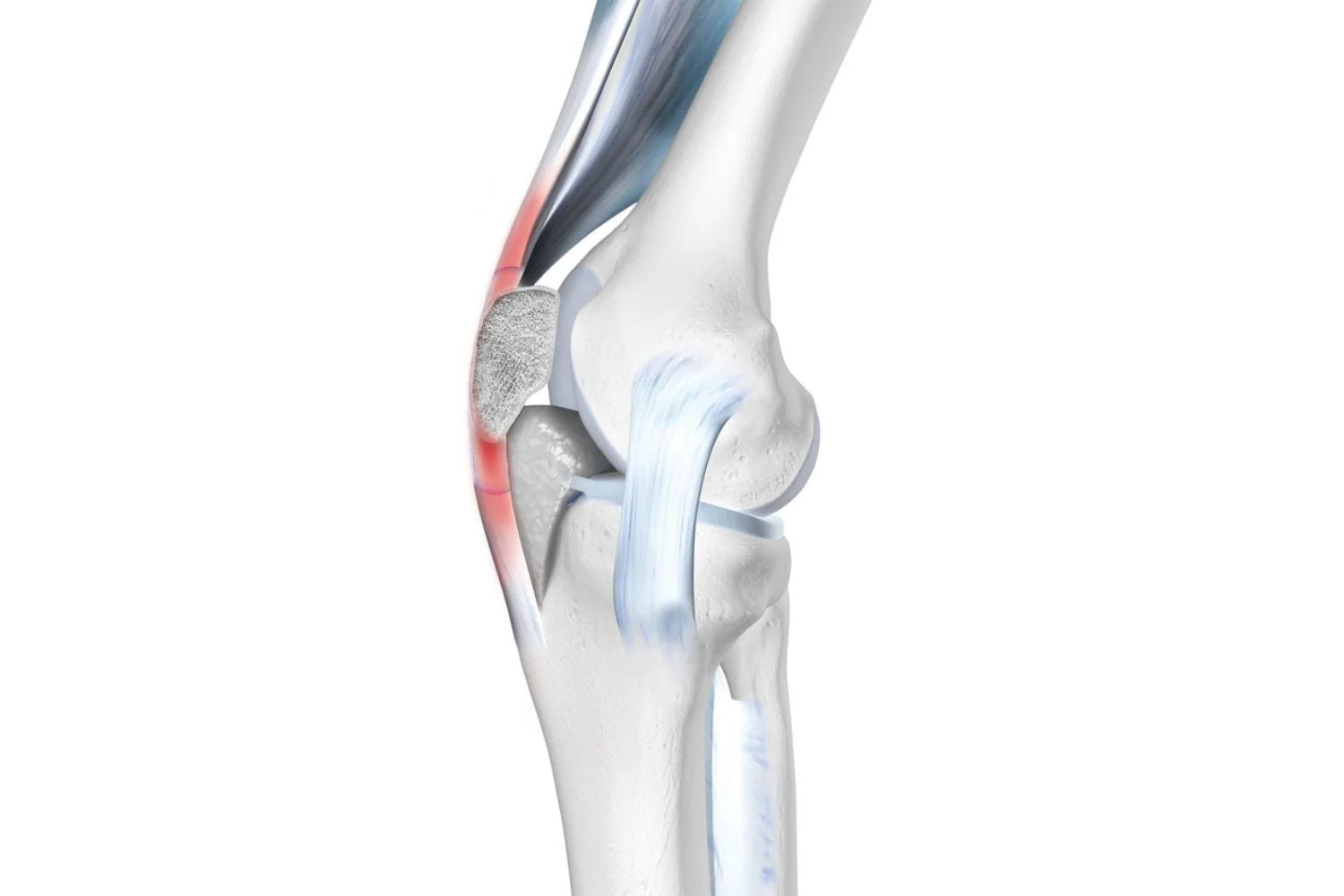 Illustration of the skeletal knee There is red throughout the patellar tendon, indicating pain from tendonitis