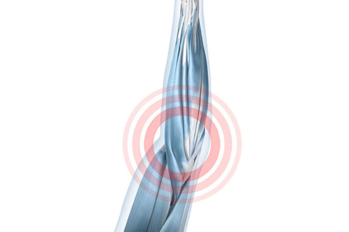 Illustration of the arm with see-through skin so you can see the underlying soft tissues. There is a rec circle around the elbow, indicating tendon attachment irritation.