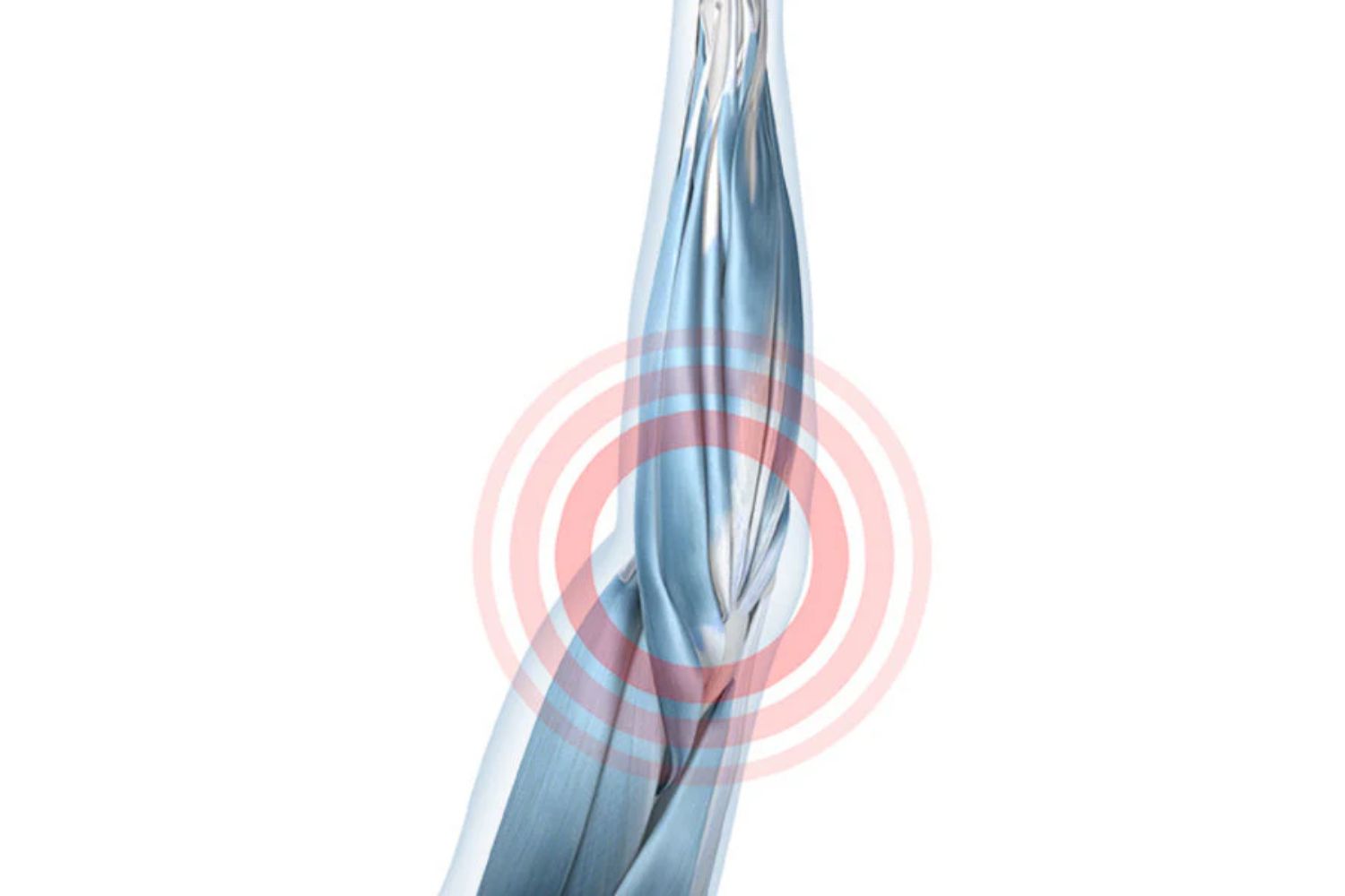 Illustration of the arm with see-through skin so you can see the underlying soft tissues. There is a rec circle around the elbow, indicating tendon attachment irritation.