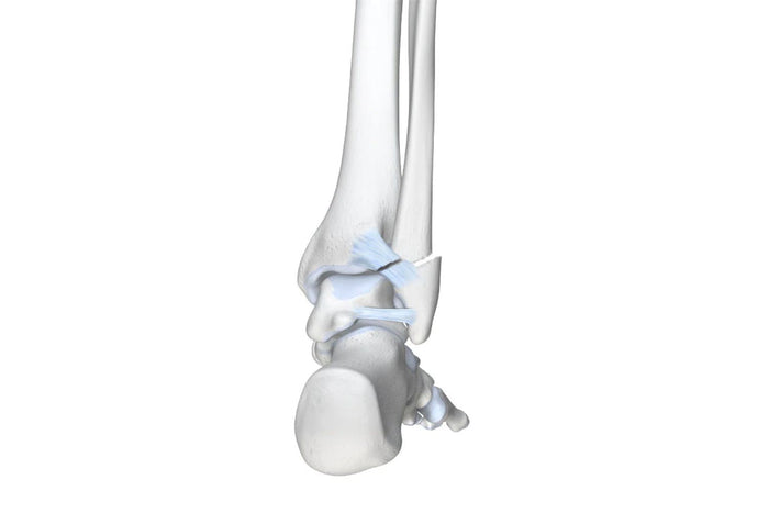 illustration of the skeletal ankle. It shows a large crack in the bone and a tear in the ligament