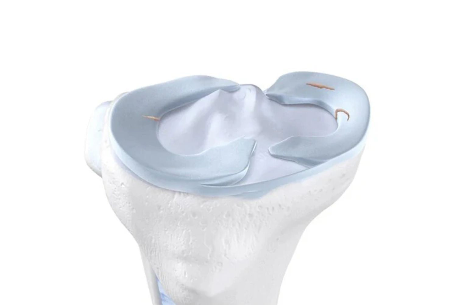 illustration of the skeletal knee with a tear in the crescent shaped meniscus cartilage