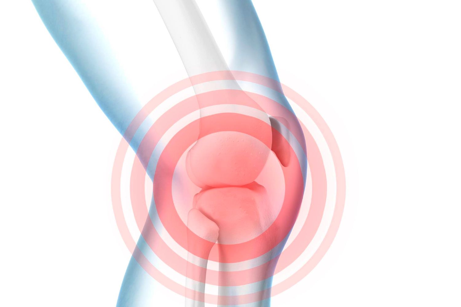 illustration of the skeletal knee with red circles radiating from the joint, indicating pain