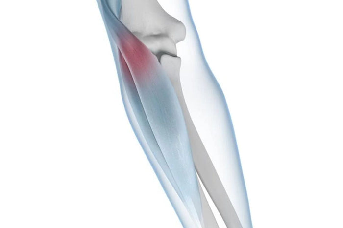 see through illustration of the arm so that the elbow bone and muscles are visible. There is a red zone of irritation around the epicondyle, indicating Tennis Elbow Pain