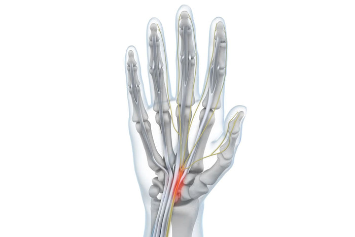 illustration of a hand with see-through skin. The carpal tunnel containing the median nerve is lit up red, indicating carpal tunnel syndrome irritation 