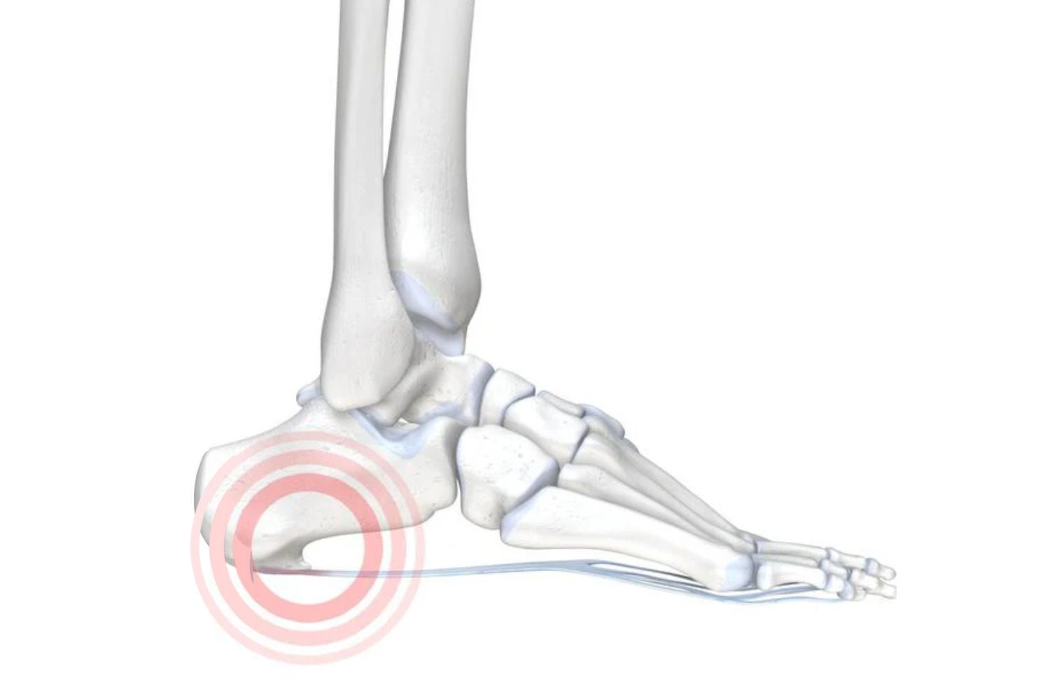 Illustration of a skeletal foot with red circles around the heel, indicating a heel spur.