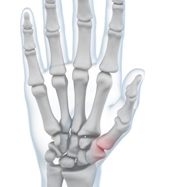 Pain in the Thumb Joint