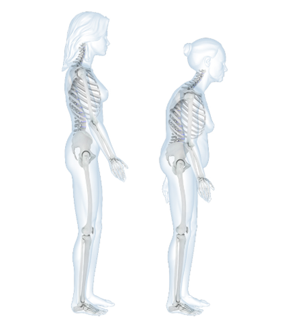 Skeletal diagram with two people, one standing straight and one with Dowagers hump