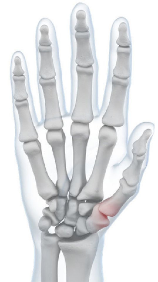 Skeletal diagram highlighting in red area of the thumb joint which is painful