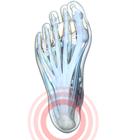 Diagram of foot highlighting in red haglund's deformity on the heel