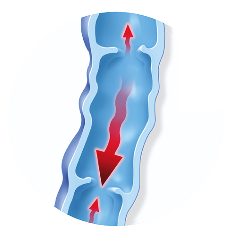 Varicose vein showing the direction of blood flow