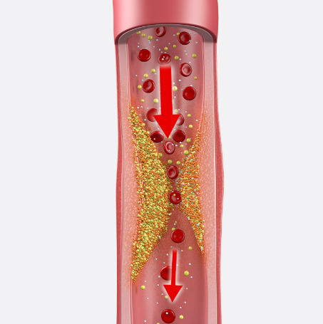 Diagram of Diabetic Angiopathy