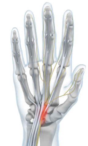 Carpal Tunnel Syndrome (CTS)